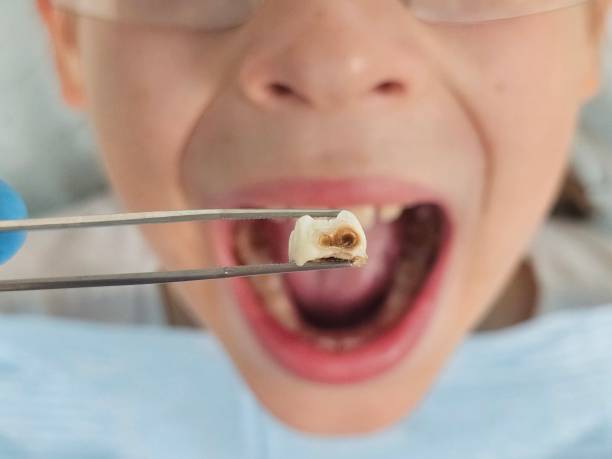 Best Emergency Treatment for Dental Infections or Abscesses in Eureka Mill, SC