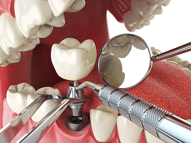 Best Emergency Dental Care for Broken or Chipped Teeth in Eureka Mill, SC
